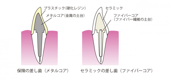 差し歯コア